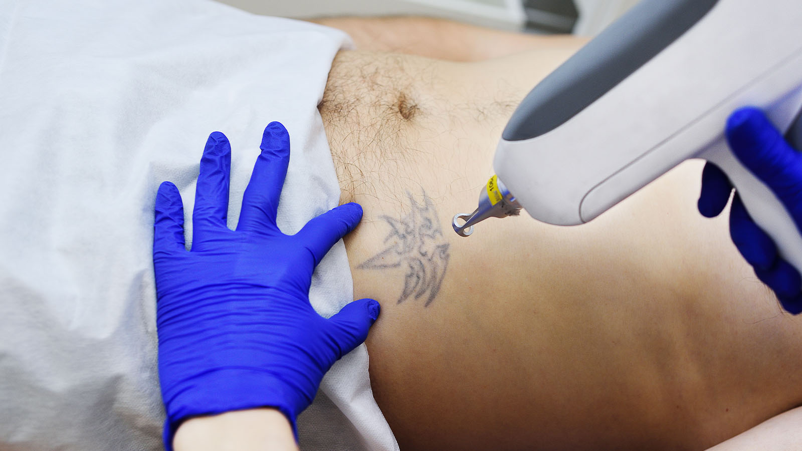 Removing Tattoos with the Picosecond Laser at Bodyland Rotterdam