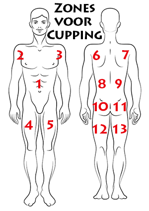 Cupping Zones