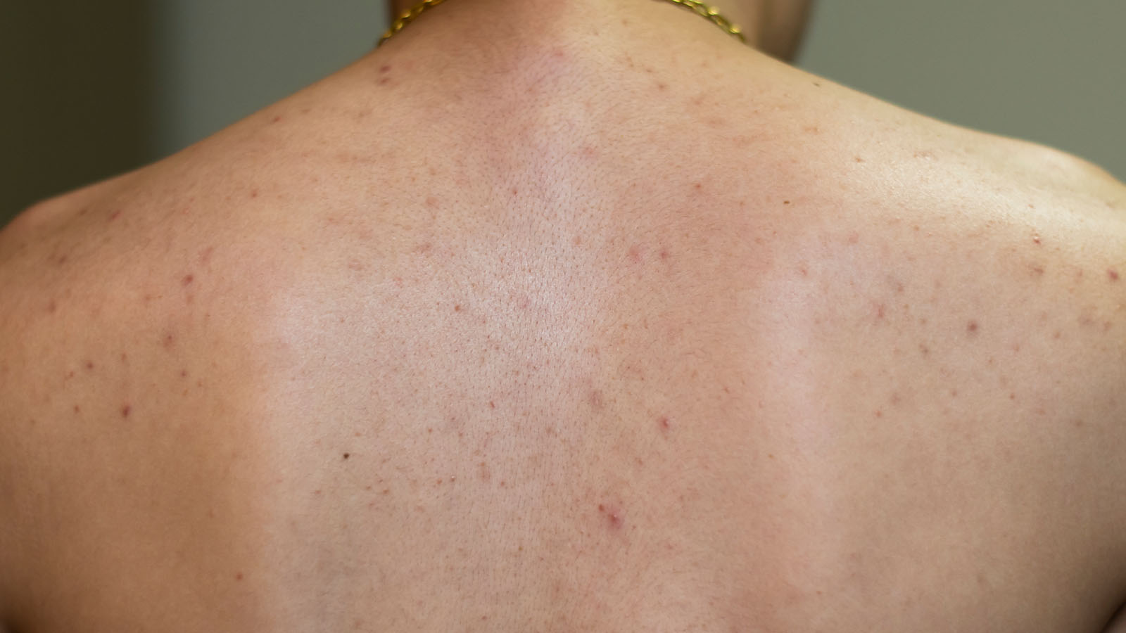 Acne Care Body Skin improvement for men at Bodyland Rotterdam