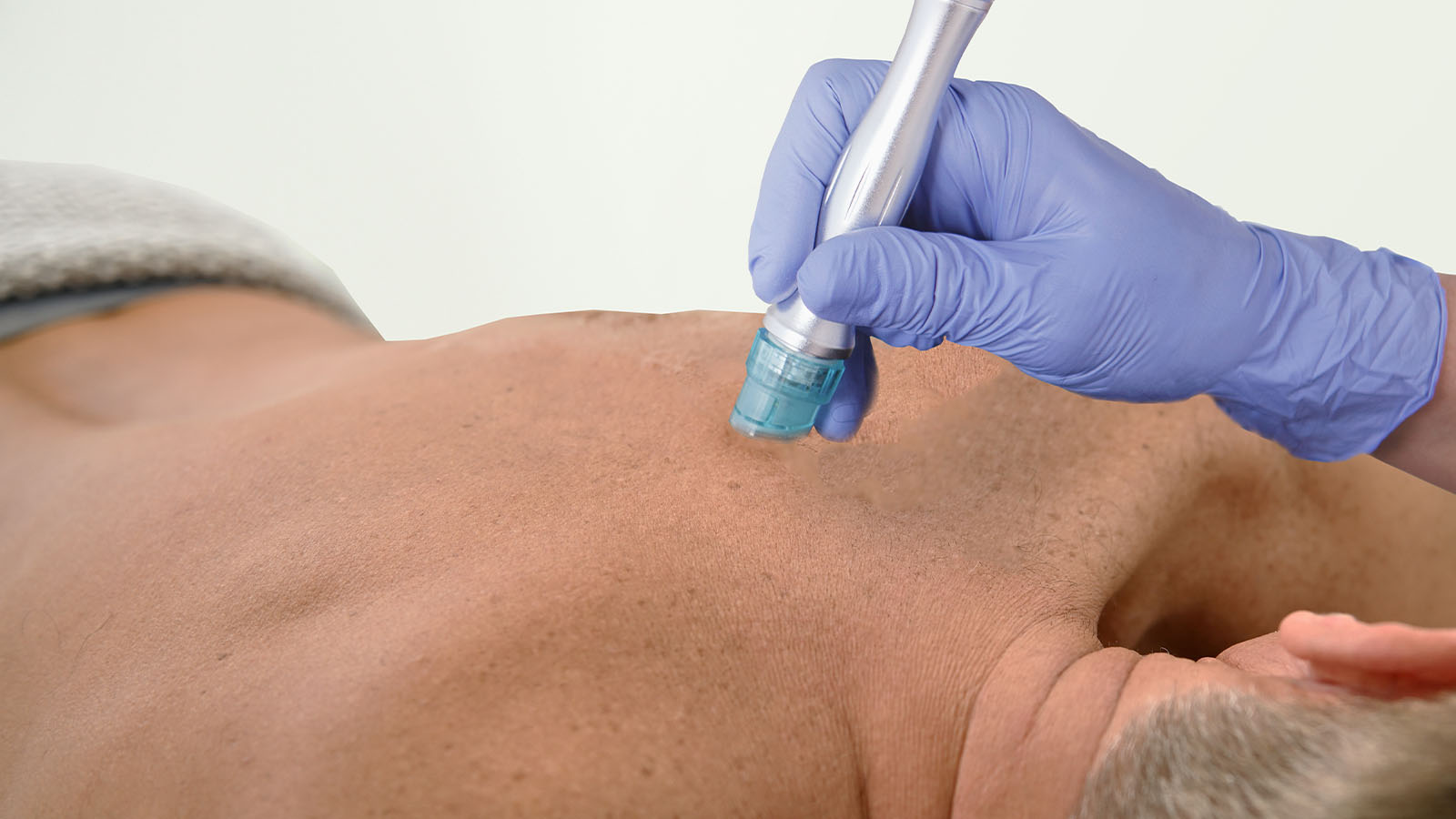 Microdermabrasion treatment for the whole body at Bodyland Rotterdam